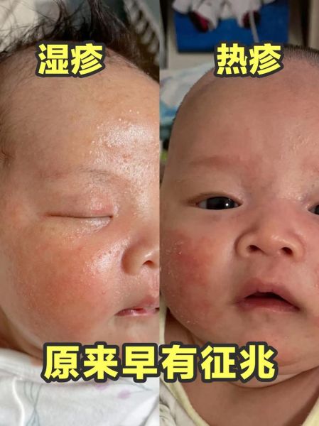 宝宝热疹怎么快速消除_热疹和湿疹的区别