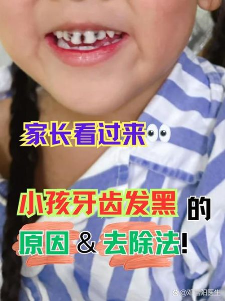 宝宝牙齿发黑怎么办_牙齿色素沉着怎么去除