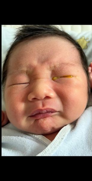 宝宝眼睛有黄色眼屎怎么办_新生儿眼屎多正常吗