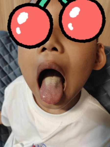 宝宝缺锌舌头图片_宝宝缺锌舌头有什么症状