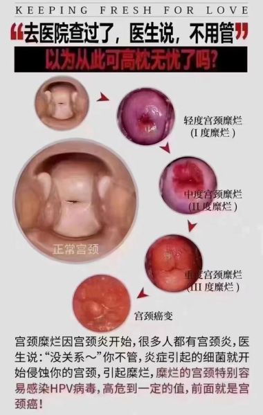 宫颈图片大全_正常与异常如何区分