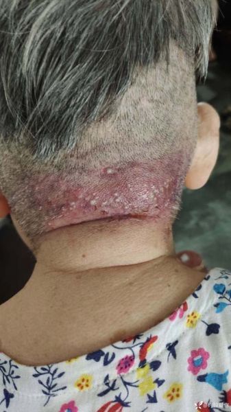 宝宝头上毛囊炎怎么办_婴儿头皮毛囊炎用什么药