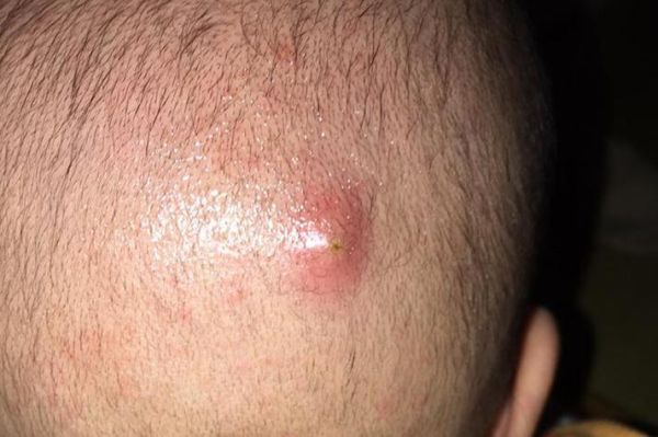 宝宝头上毛囊炎怎么办_婴儿头皮毛囊炎用什么药