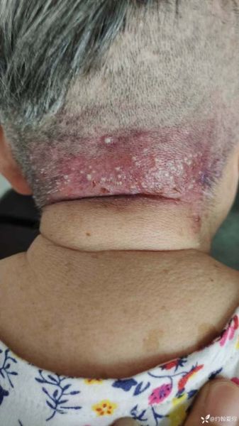 宝宝头上毛囊炎怎么办_婴儿头皮毛囊炎用什么药