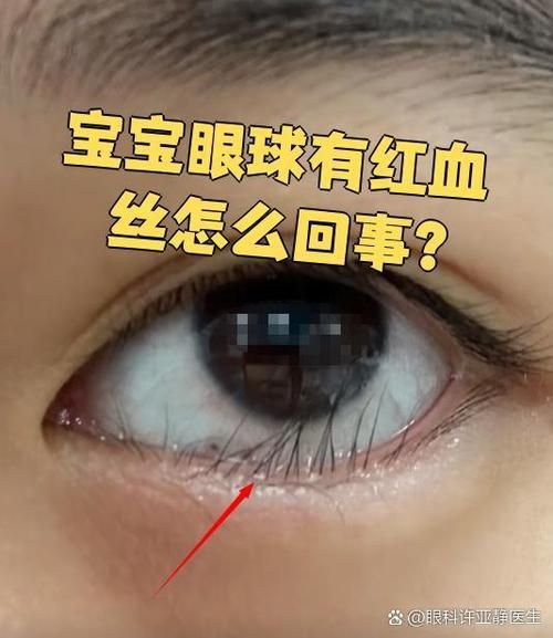 1岁宝宝眼睛有红血丝怎么办_1岁宝宝眼睛红血丝的原因