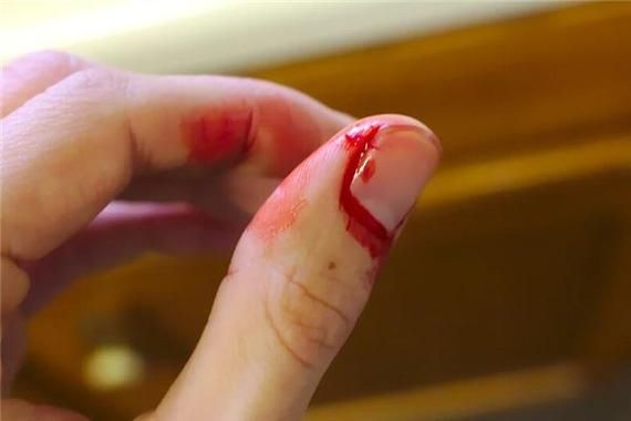 梦到开刀是什么意思_梦见自己开刀手术预示什么