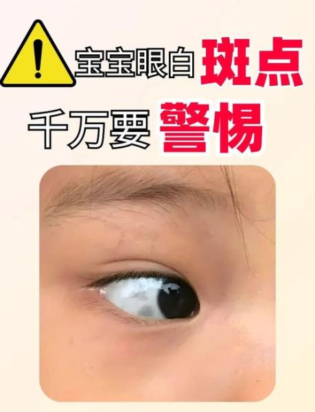 宝宝眼睛有黑点怎么办_宝宝眼睛黑点会消失吗