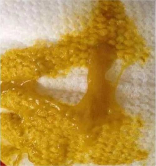 宝宝大便有粘液正常吗_需要看医生吗