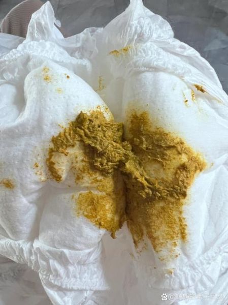 宝宝大便有粘液正常吗_需要看医生吗