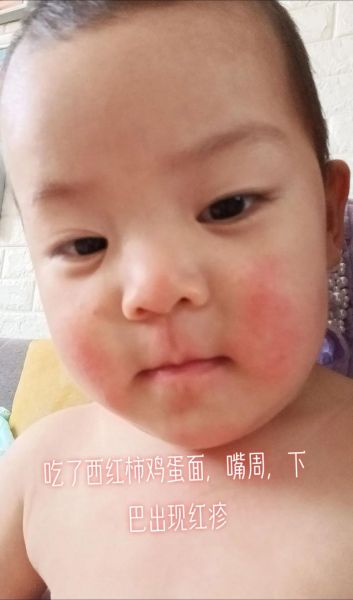 宝宝可以吃火龙果吗_火龙果过敏症状