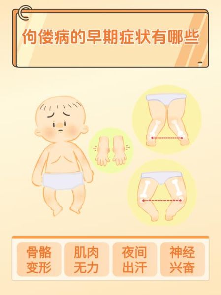 宝宝佝偻病的早期症状图片_如何辨别佝偻病初期表现