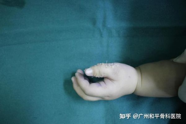 宝宝六指的原因_六指会遗传吗