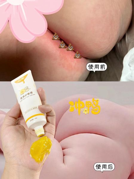 宝宝红屁屁怎么办_红屁屁多久能好