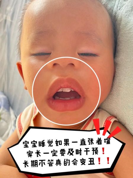 宝宝总是张着嘴_会影响发育吗