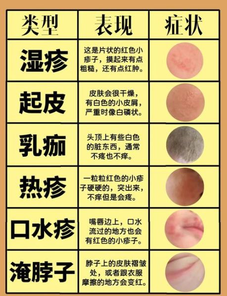 宝宝湿疹怎么预防_宝宝湿疹预防方法