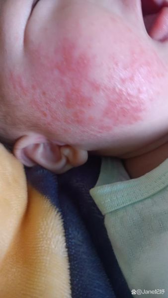 宝宝嘴边湿疹怎么处理_婴儿口周湿疹反复怎么办