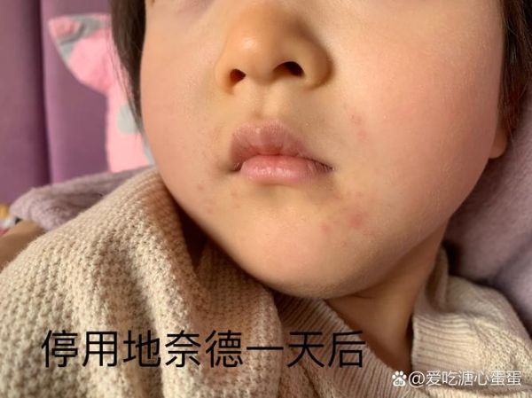 宝宝嘴边湿疹怎么处理_婴儿口周湿疹反复怎么办