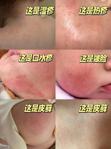 宝宝过敏图片_如何辨别食物过敏还是湿疹